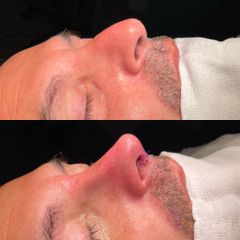 Rinoplastia - Dr. Alberto Cuevas