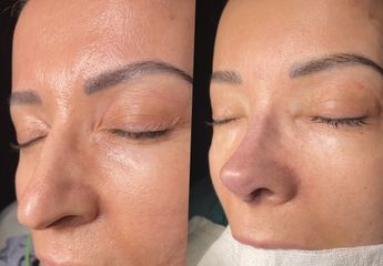Rinoplastia - Dr. Alberto Cuevas