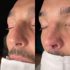 Rinoplastia - Dr. Alberto Cuevas