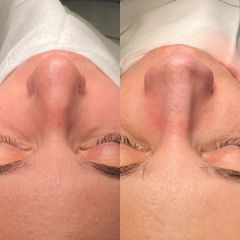 Rinoplastia - Dr. Alberto Cuevas