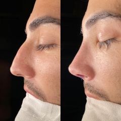 Rinoplastia - Dr. Alberto Cuevas