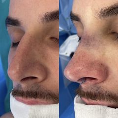 Rinoplastia - Dr. Alberto Cuevas