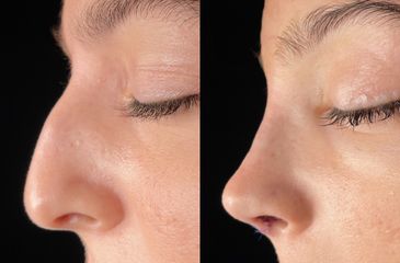 Rinoplastia - Dr. Alberto Cuevas