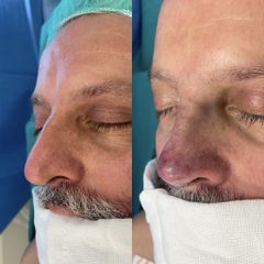 Rinoplastia - Dr. Alberto Cuevas
