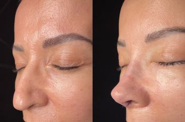 Rinoplastia - Dr. Alberto Cuevas