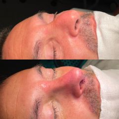 Rinoplastia - Dr. Alberto Cuevas
