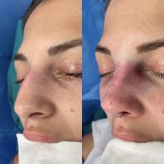 Rinoplastia - Dr. Alberto Cuevas
