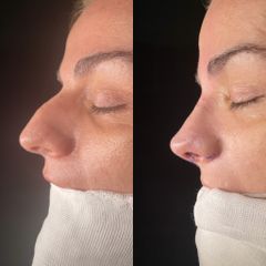 Rinoplastia - Dr. Alberto Cuevas