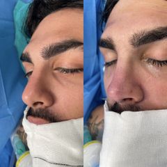 Rinoplastia - Dr. Alberto Cuevas