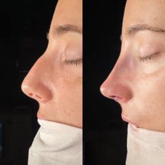 Rinoplastia - Dr. Alberto Cuevas