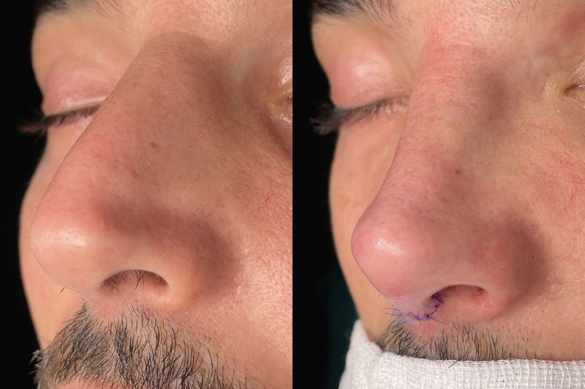 Rinoplastia antes y después - 874726