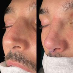 Rinoplastia - Dr. Alberto Cuevas