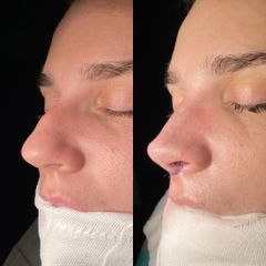 Rinoplastia - Dr. Alberto Cuevas