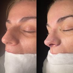 Rinoplastia - Dr. Alberto Cuevas