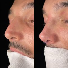 Rinoplastia - Dr. Alberto Cuevas