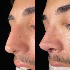 Rinoplastia - Dr. Alberto Cuevas