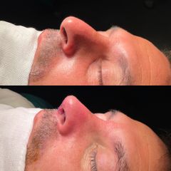 Rinoplastia - Dr. Alberto Cuevas