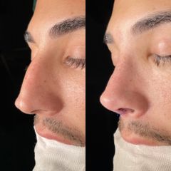Rinoplastia - Dr. Alberto Cuevas