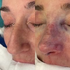 Rinoplastia - Dr. Alberto Cuevas