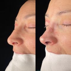 Rinoplastia - Dr. Alberto Cuevas