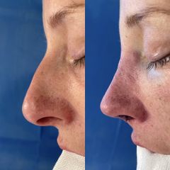 Rinoplastia - Dr. Alberto Cuevas