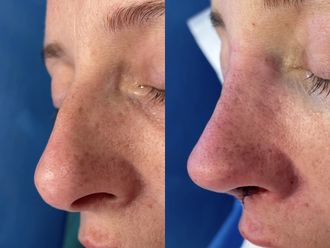 Rinoplastia antes y después - 874814