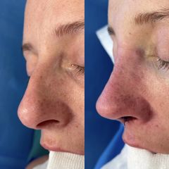 Rinoplastia - Dr. Alberto Cuevas