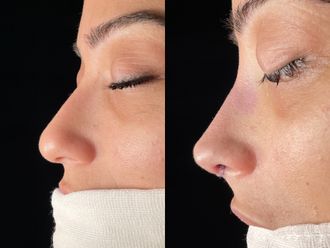 Rinoplastia antes y después - 874815