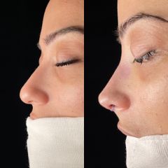 Rinoplastia - Dr. Alberto Cuevas