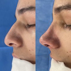 Rinoplastia - Dr. Alberto Cuevas