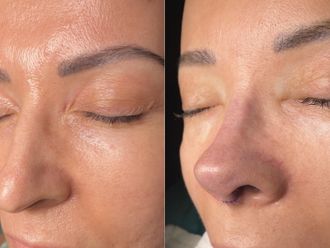 Rinoplastia antes y después - 874817