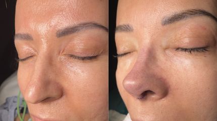 Rinoplastia - Dr. Alberto Cuevas