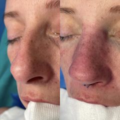 Dr. Alberto Cuevas - Rinoplastia