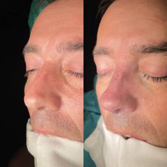 Dr. Alberto Cuevas - Rinoplastia