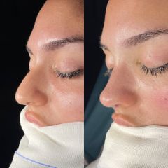 Dr. Alberto Cuevas - Rinoplastia