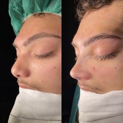 Dr. Alberto Cuevas - Rinoplastia