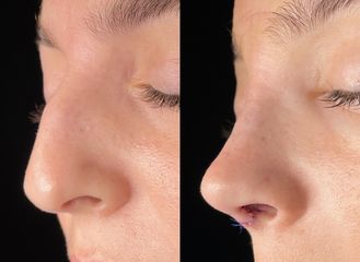 Dr. Alberto Cuevas - Rinoplastia