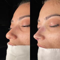 Dr. Alberto Cuevas - Rinoplastia
