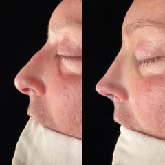 Dr. Alberto Cuevas - Rinoplastia