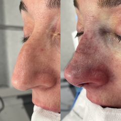 Dr. Alberto Cuevas - Rinoplastia