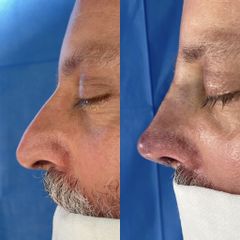 Dr. Alberto Cuevas - Rinoplastia