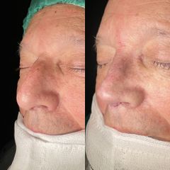 Dr. Alberto Cuevas - Rinoplastia