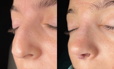 Dr. Alberto Cuevas - Rinoplastia