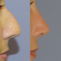 Dr. Alberto Cuevas - Rinoplastia
