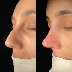 Dr. Alberto Cuevas - Rinoplastia