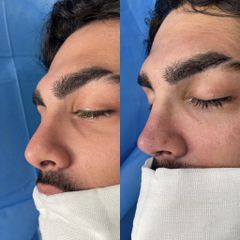 Dr. Alberto Cuevas - Rinoplastia