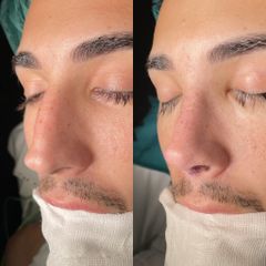 Dr. Alberto Cuevas - Rinoplastia