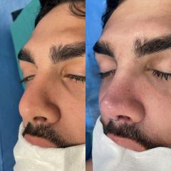Dr. Alberto Cuevas - Rinoplastia