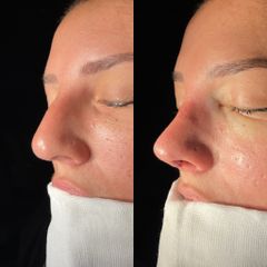 Dr. Alberto Cuevas - Rinoplastia