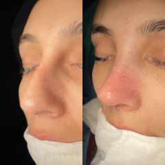 Dr. Alberto Cuevas - Rinoplastia